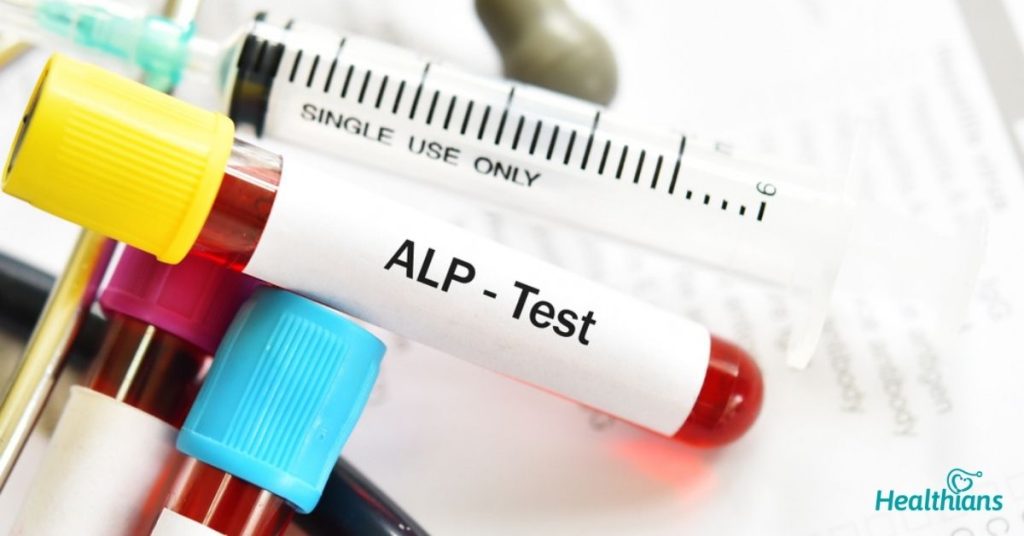 آزمایش ALP (آلکالین فسفاتاز)