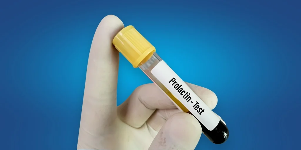آزمایش پرولاکتین (Prolactin)