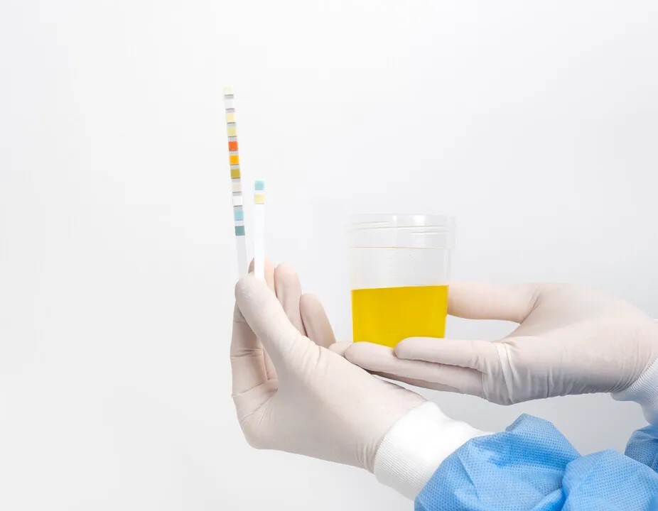 آزمایش ادرار (Urine Analysis)