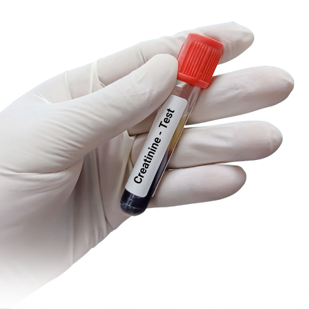 آزمایش کراتینین (Creatinine)