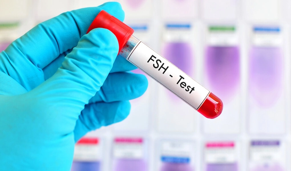 آزمایش هورمون محرک فولیکول (FSH)