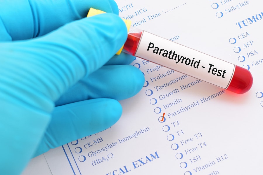 آزمایش PTH (هورمون پاراتیروئید)